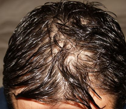wet scalp area of a man. hair growth tips for men