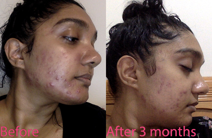 overexfoliation before after comparison. tips to getting rid of acne 2