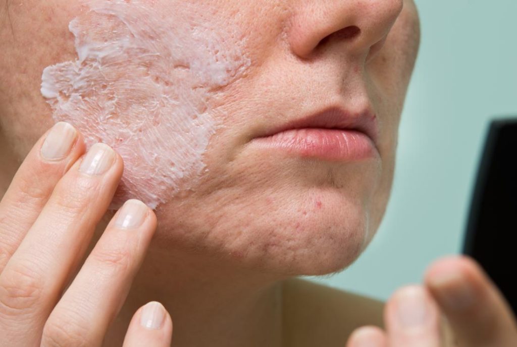 woman applying acne cream. how to stop acne 6