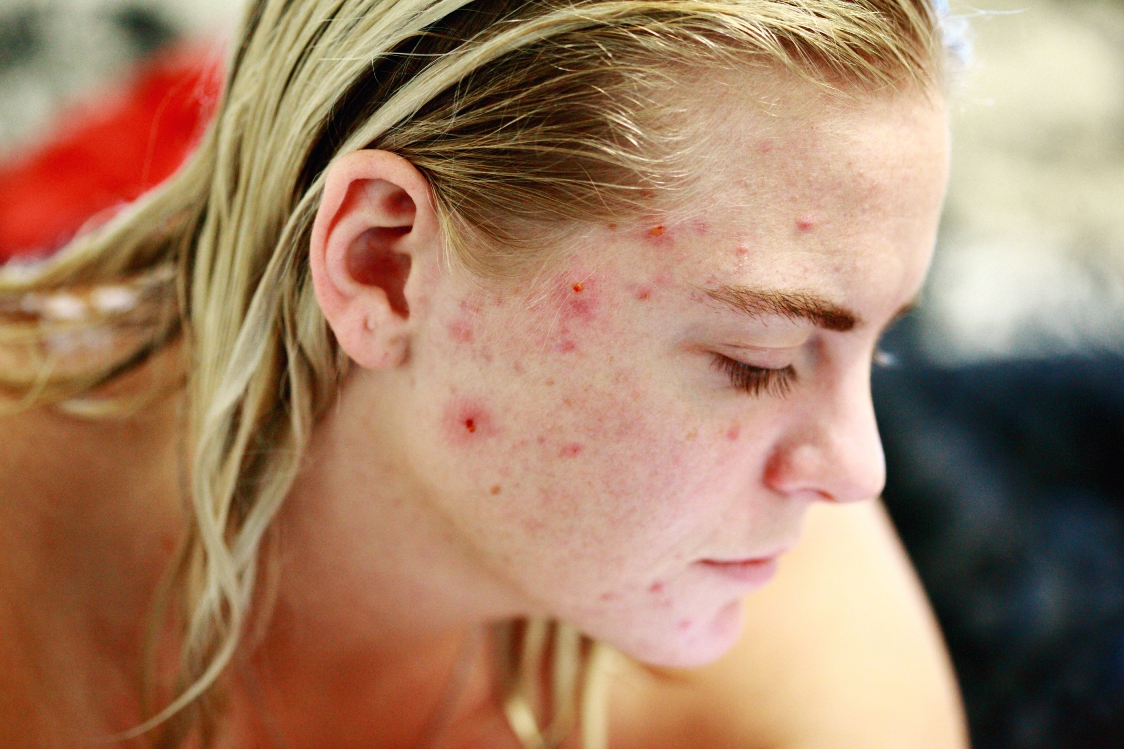 woman with face acne. how to stop acne