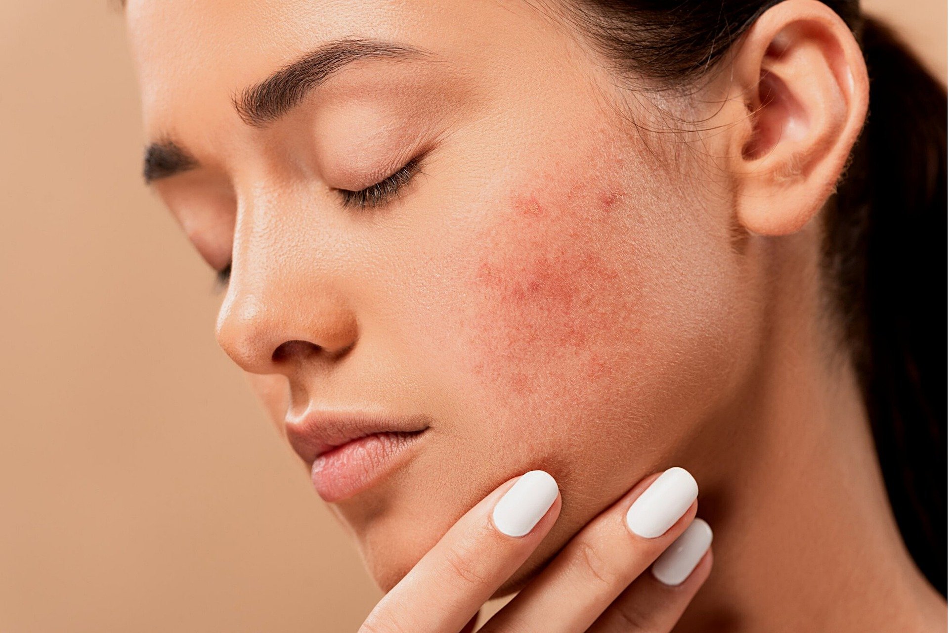 acne on woman face. acne